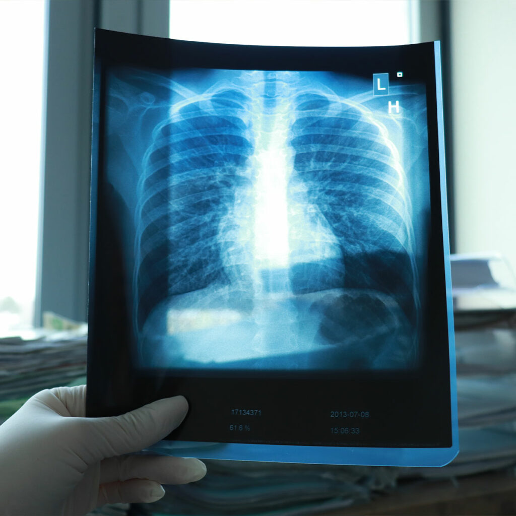 Doctor holding Lung X-Ray